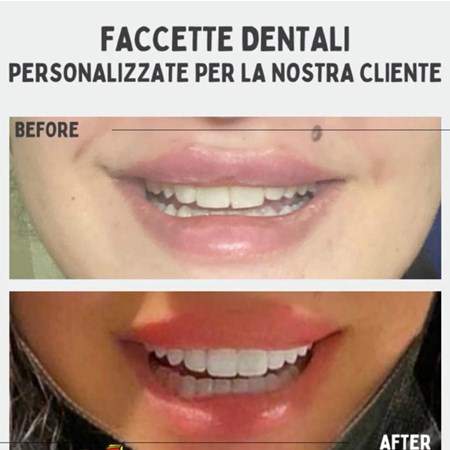 Faccette dentali